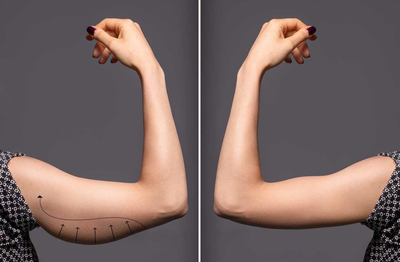 Lipo HD Braços