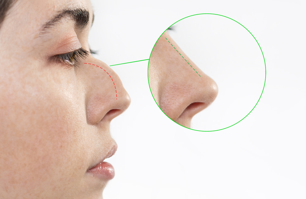 Rinoplastia