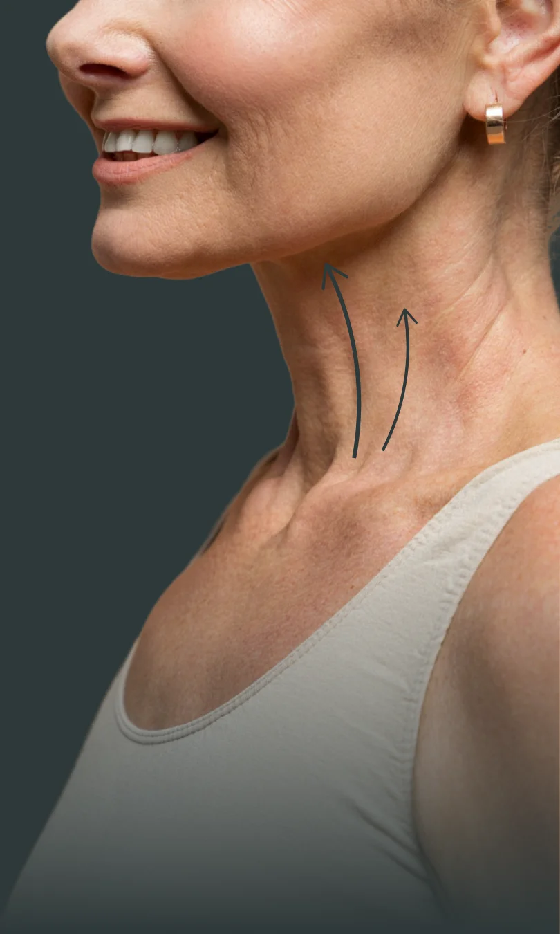 Platisma ou Deep Neck