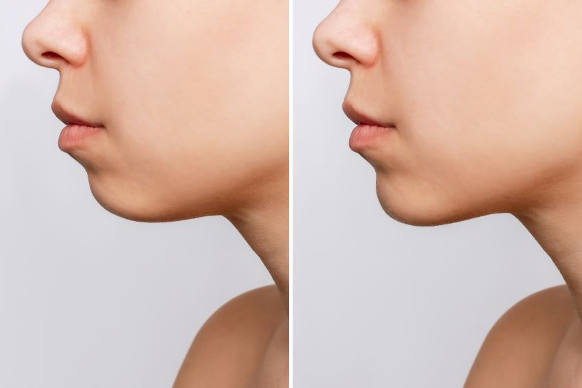 Mentoplastia