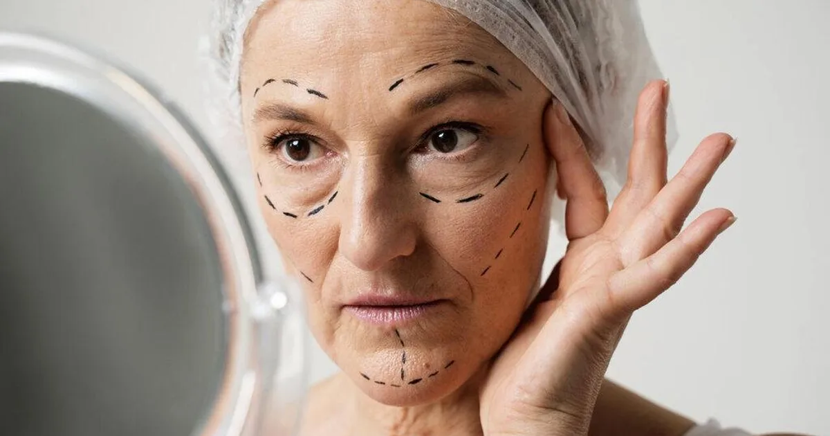 Facelifting completo ou Ritidoplastia