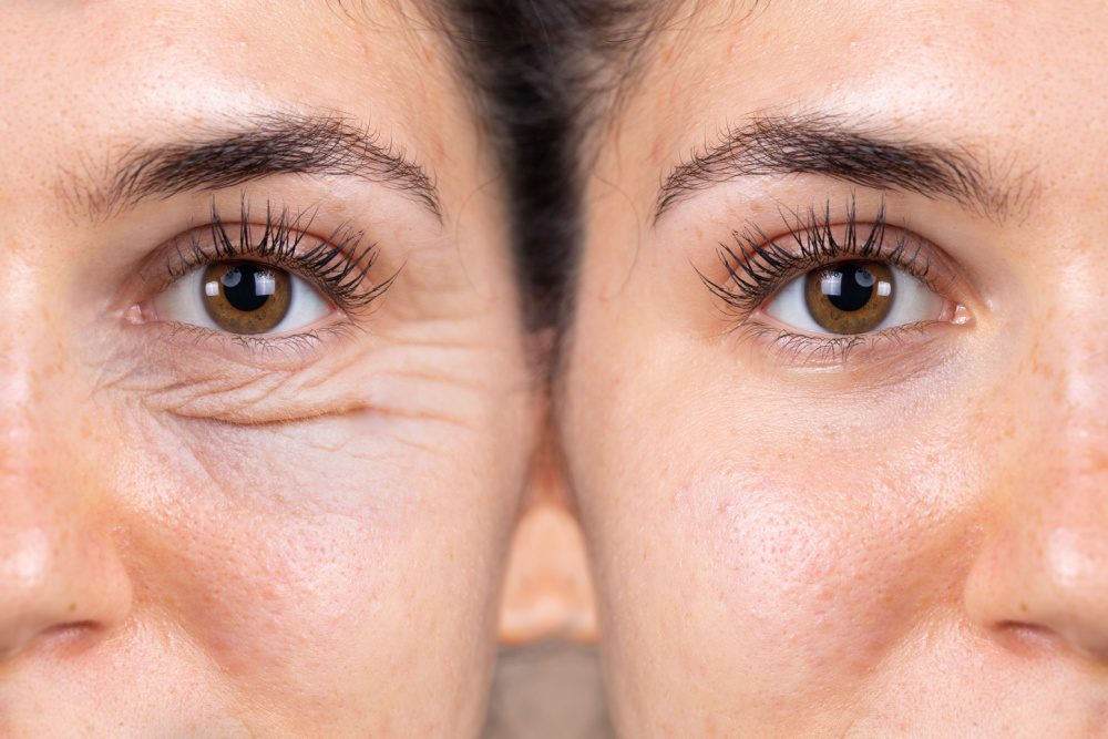 Blefaroplastia